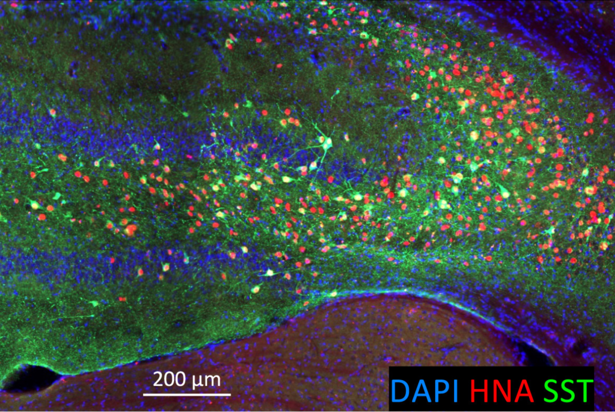 Neurona Therapeutics, stem cells for epilepsy