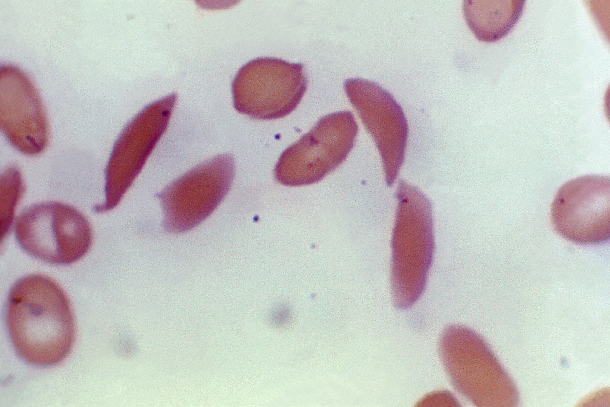Crescent-shaped red blood cells from a person with sickle cell disease are viewed under a microscope in 1972.