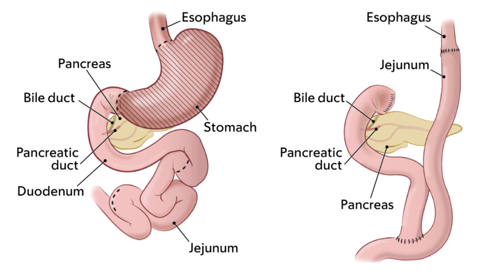 Two medical illustrations of gastrointestinal anatomy. One illustration shows normal GI anatomy with dotted lines where incisions are made during total gastrectomy surgery, and the other shows GI anatomy after a total gastrectomy.