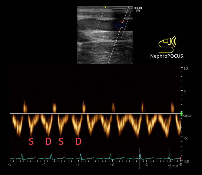 Femoral Vein Doppler Before And After Dialysis - Renal.PlatoHealth.ai