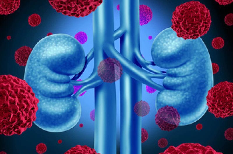 Lenvatinib Plus Everolimus For Patients With Metastatic Kidney Cancer - Action Kidney Cancer - Renal.PlatoHealth.ai