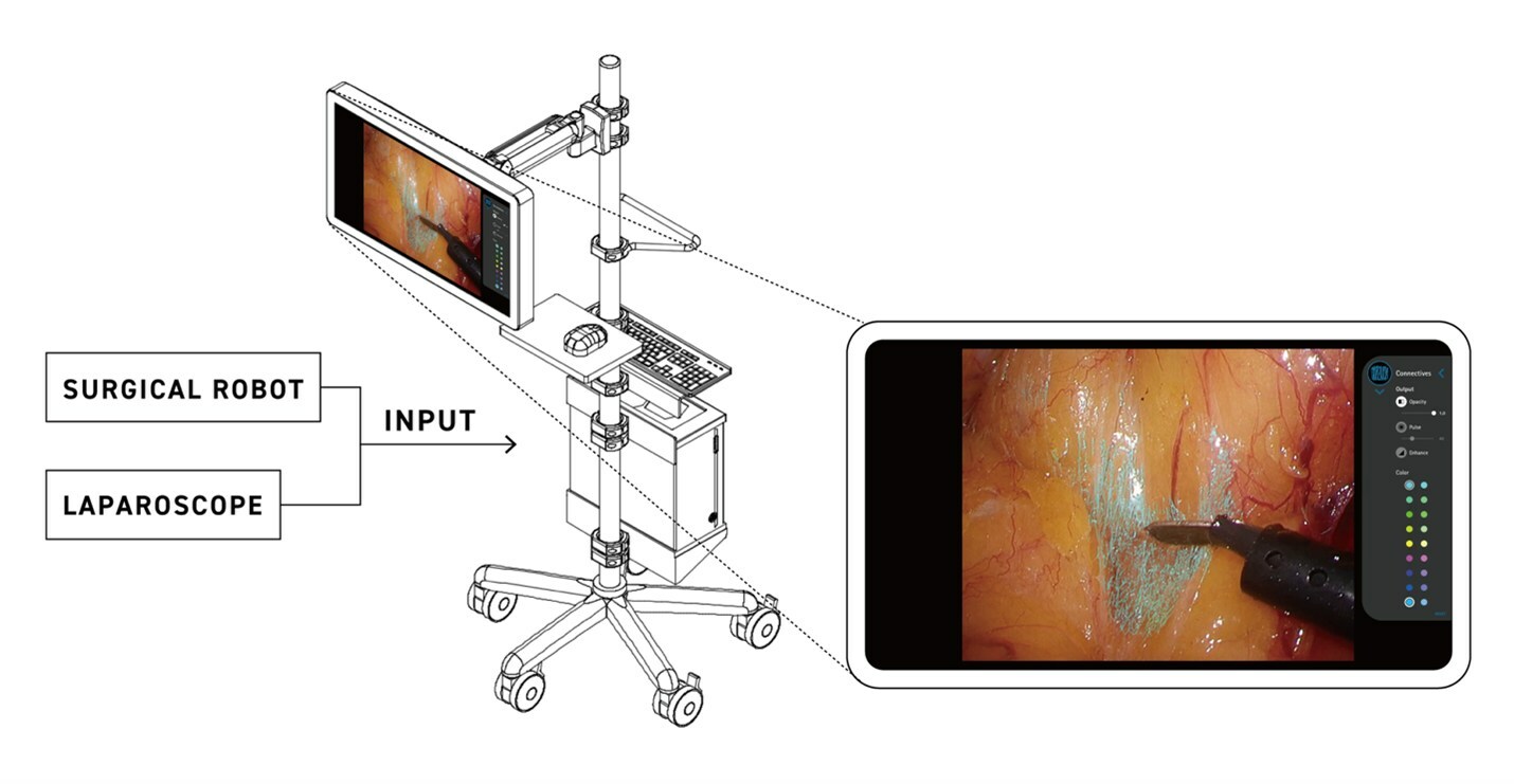 Anaut Announces Japanese Regulatory Approval Of AI-Powered Surgical Visualization Tool, Eureka α - Medical Device News Magazine