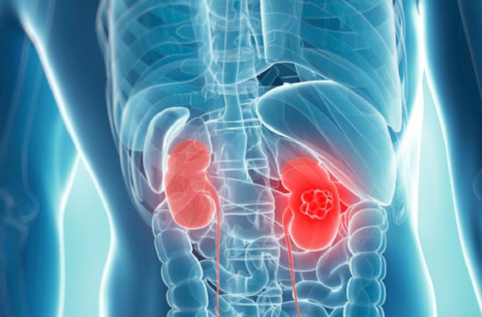 Comparison Of Cabozantinib With Axitinib As Second-line Treatment For Metastatic Kidney Cancer - Action Kidney Cancer - Renal.PlatoHealth.ai