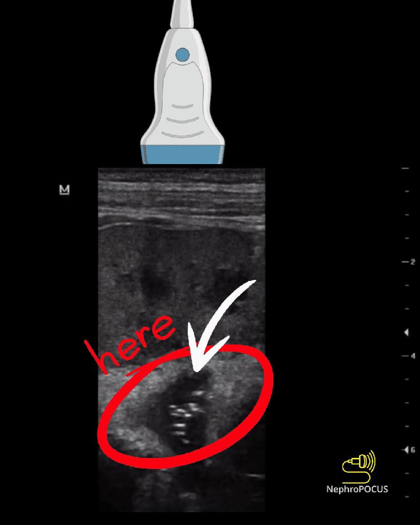 Emphysematous Pyelonephritis: A Diagnosis Not To Be Missed On POCUS - Renal.PlatoHealth.ai