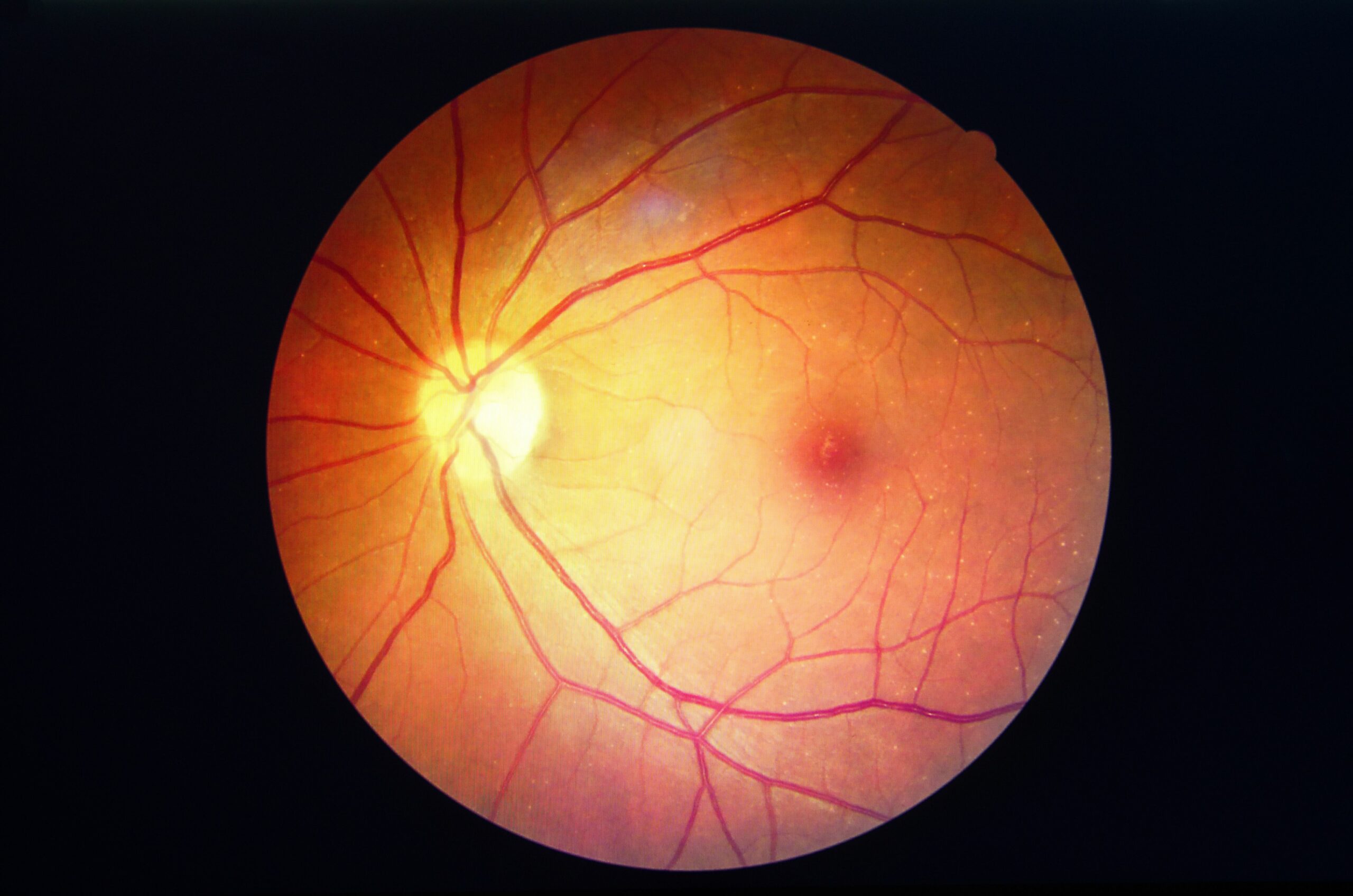 First Worldwide Clinical Trial for Diabetic Macular Ischemia​ Treatment Achieves Primary Safety Endpoints