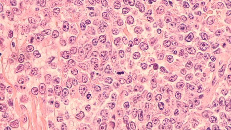 diffuse large B-cell lymphoma (DLBCL) ViPOR